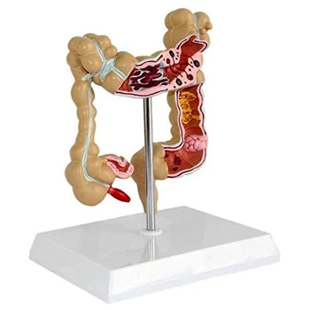 NOVO-Model patološke debelog crijeva rak debelog crijeva, Model debelog crijeva, Анатомическая model gastrointestinalnog trakta